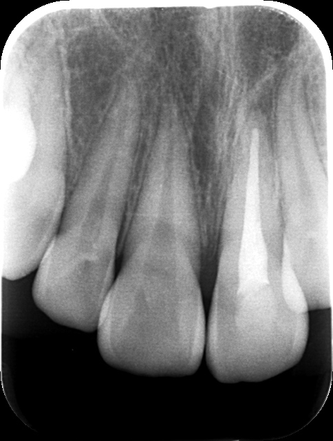 前歯にボールがあたり抜け落ちた症例(移植5ヶ月後)