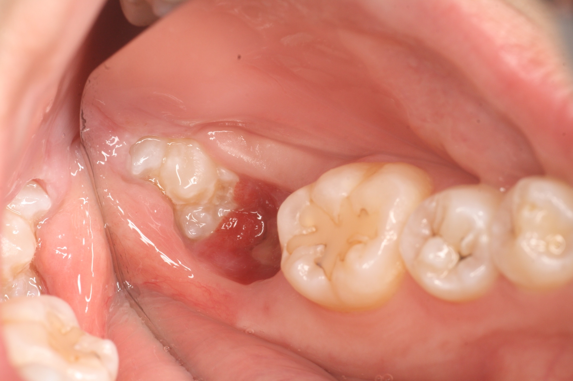 歯の移植の症例(移植直前)