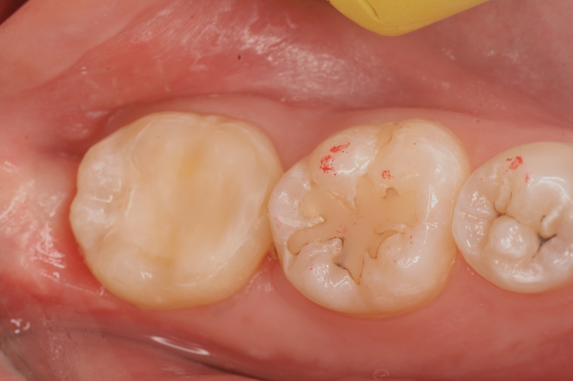 歯の移植の症例(移植後)