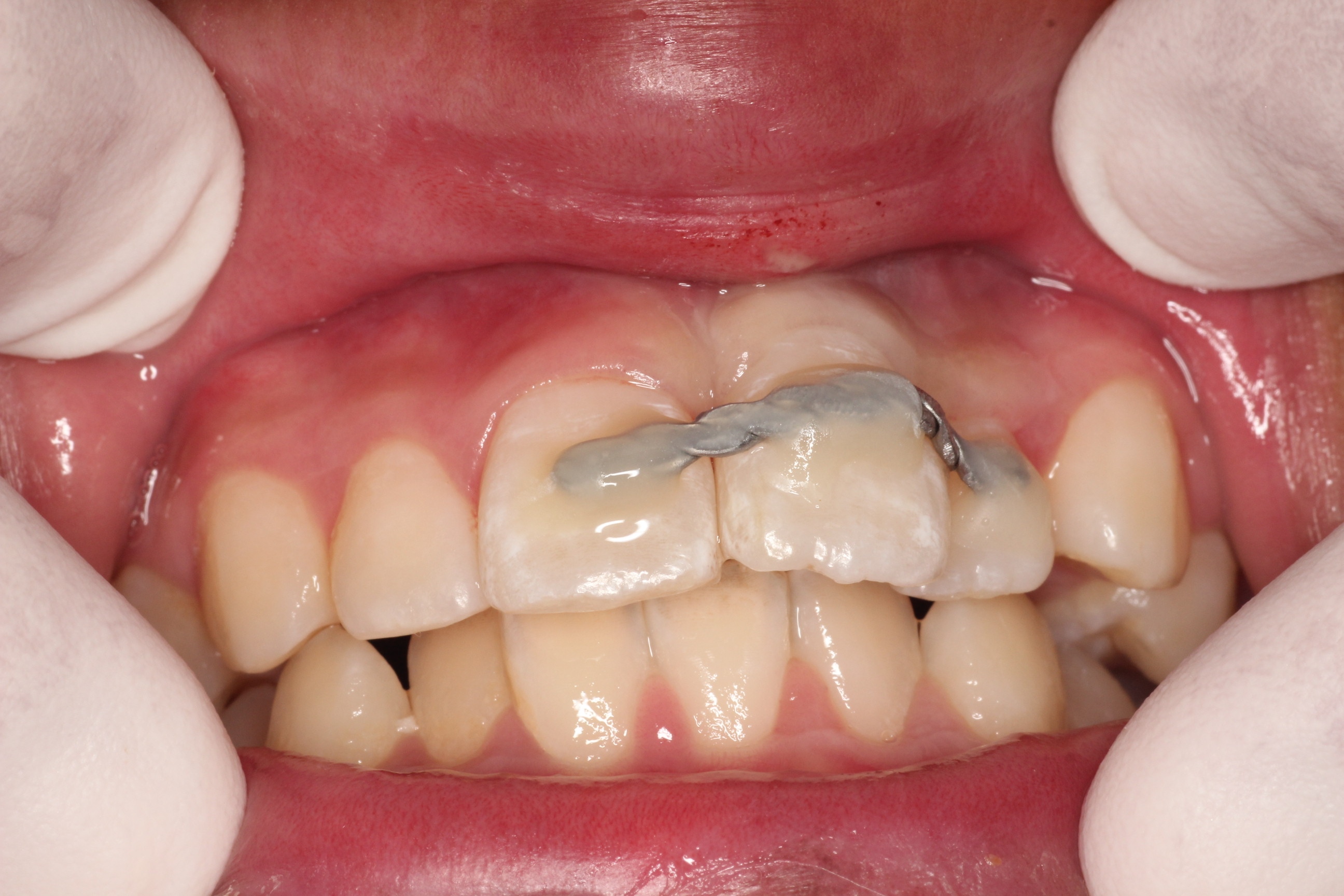 前歯にボールがあたり抜け落ちた症例(初診)