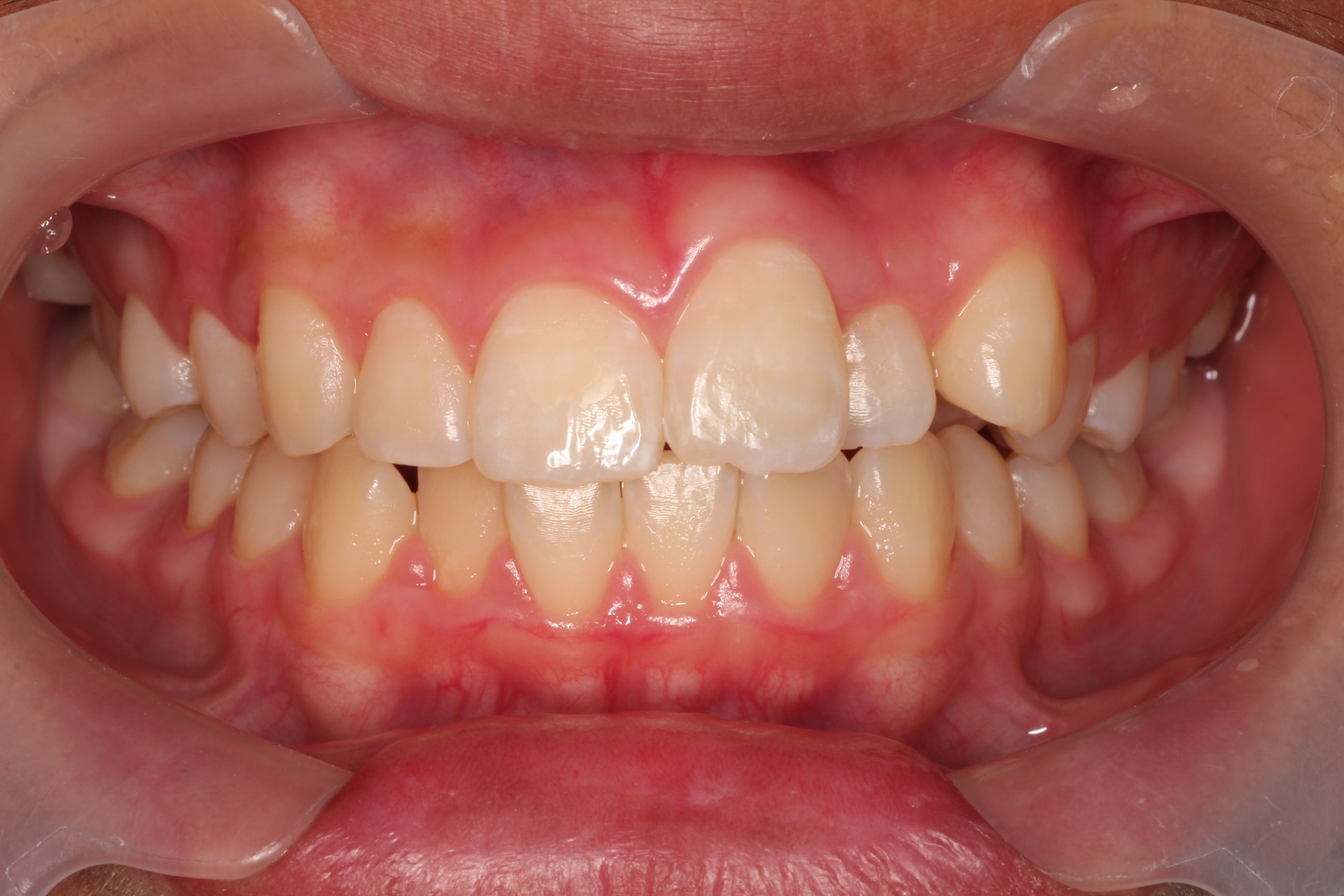 前歯にボールがあたり抜け落ちた症例(移植5ヶ月後)