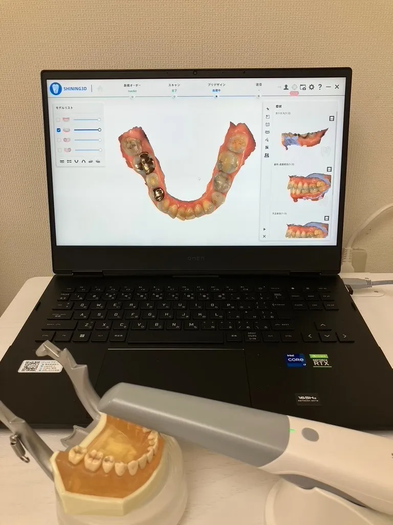 口腔内スキャナー(Intra Oral Scanner)