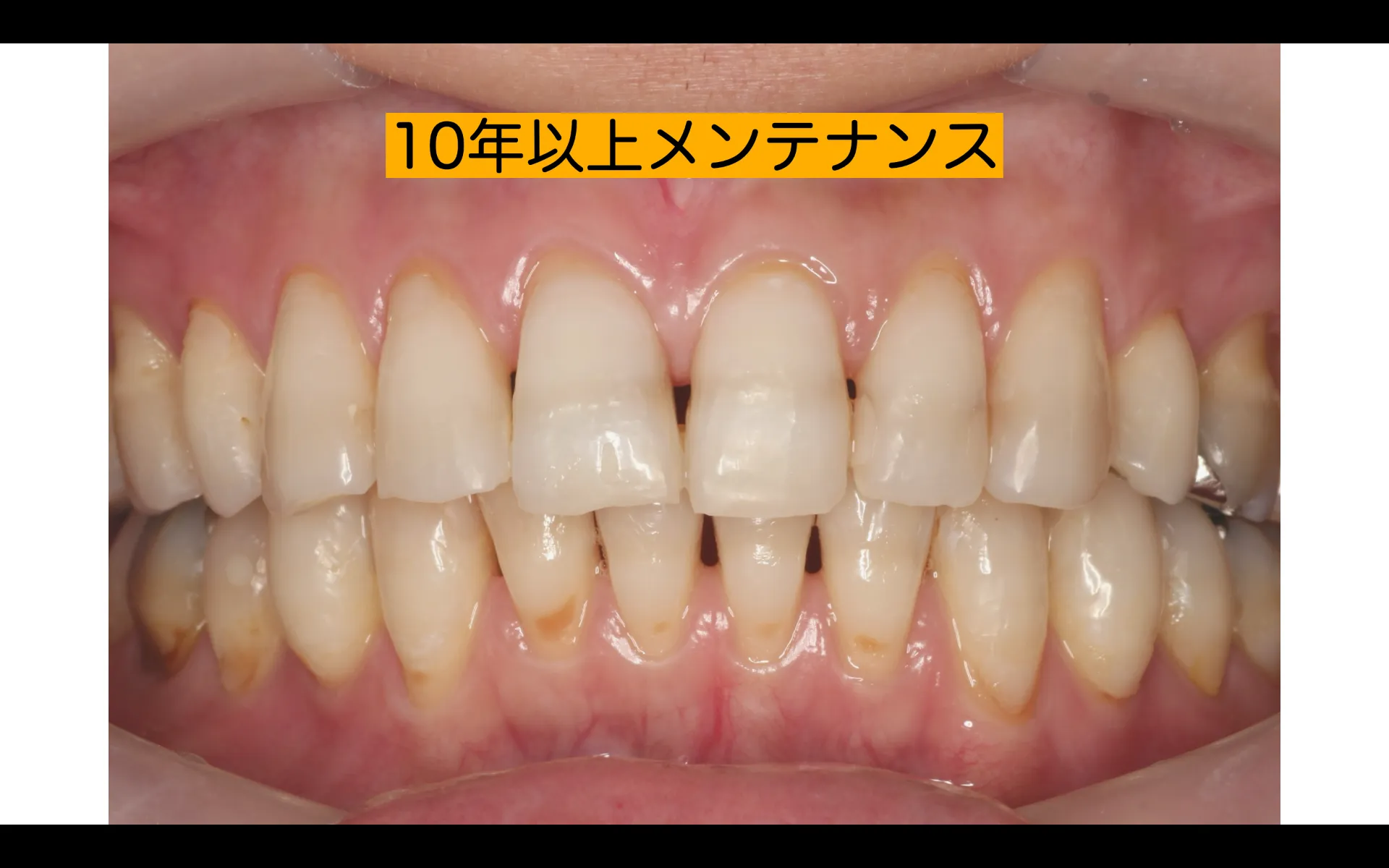 10年以上メンテナンスに来られてる患者様