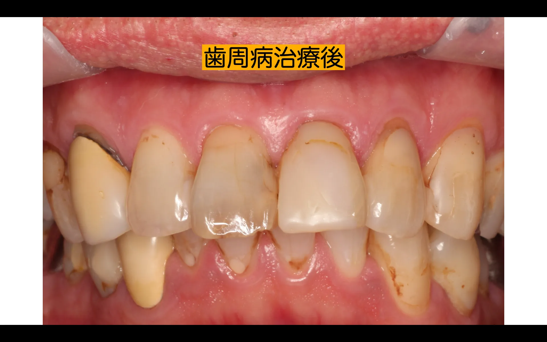 歯周病治療、セラミック治療