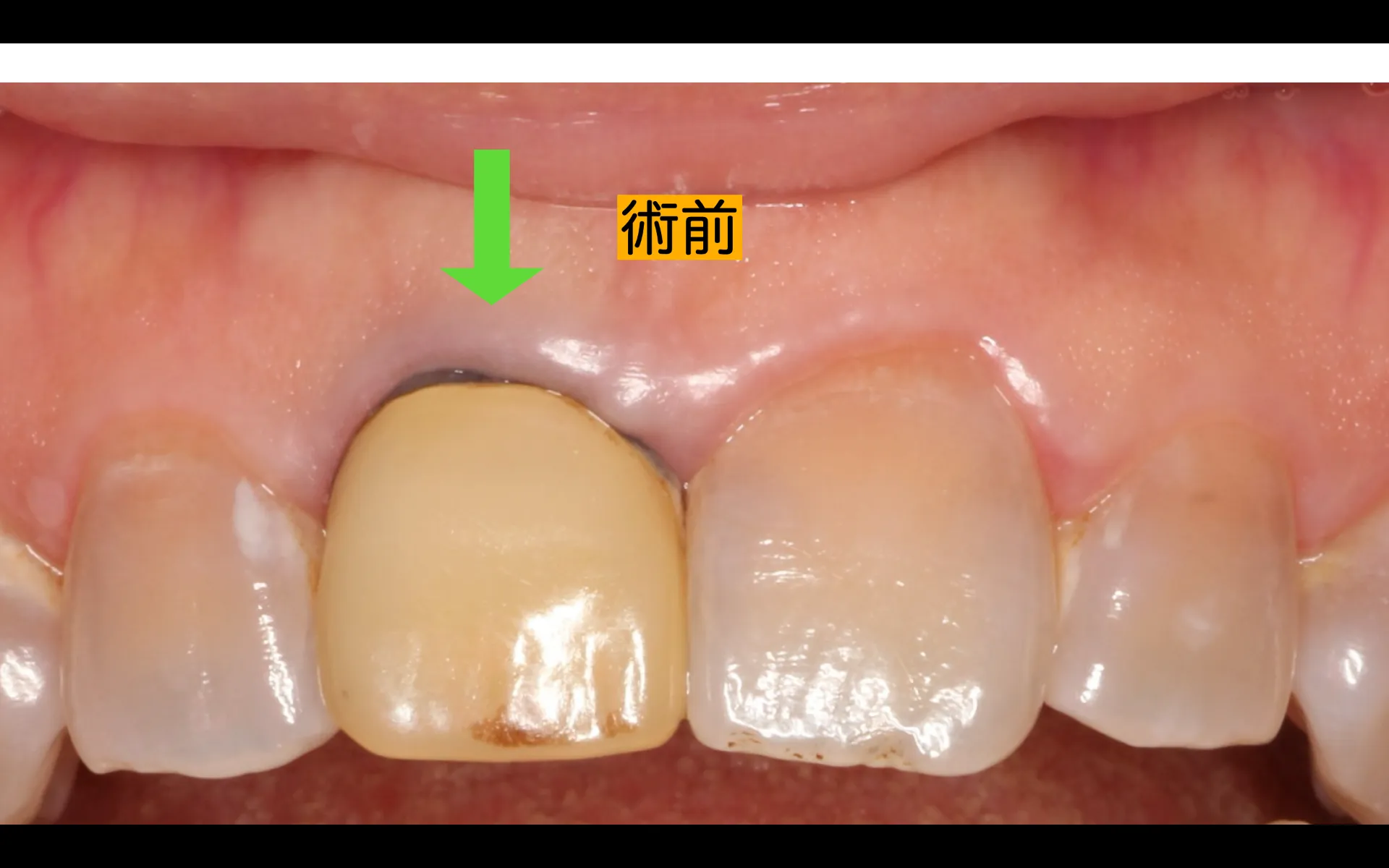 前歯セラミック治療
