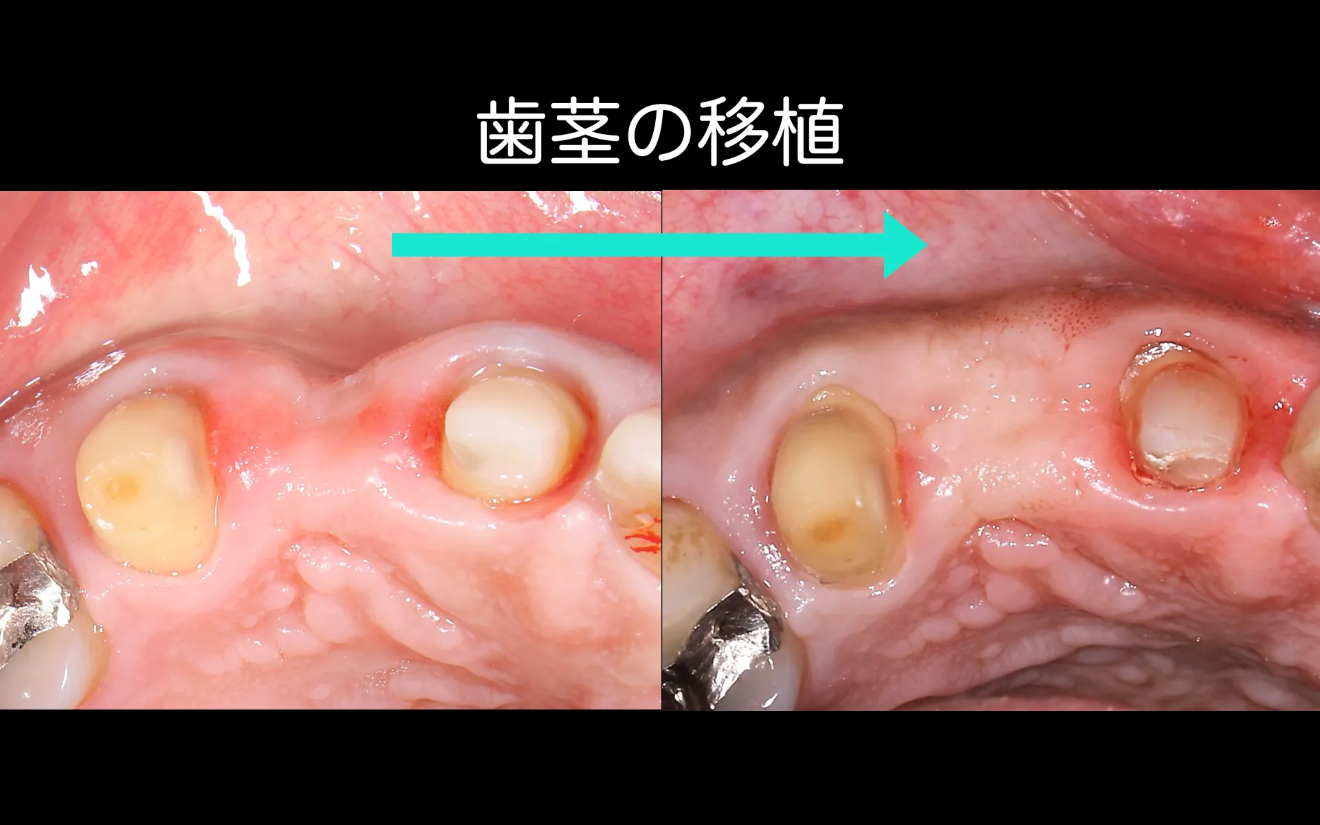 前歯セラミック治療（軟組織移植併用）