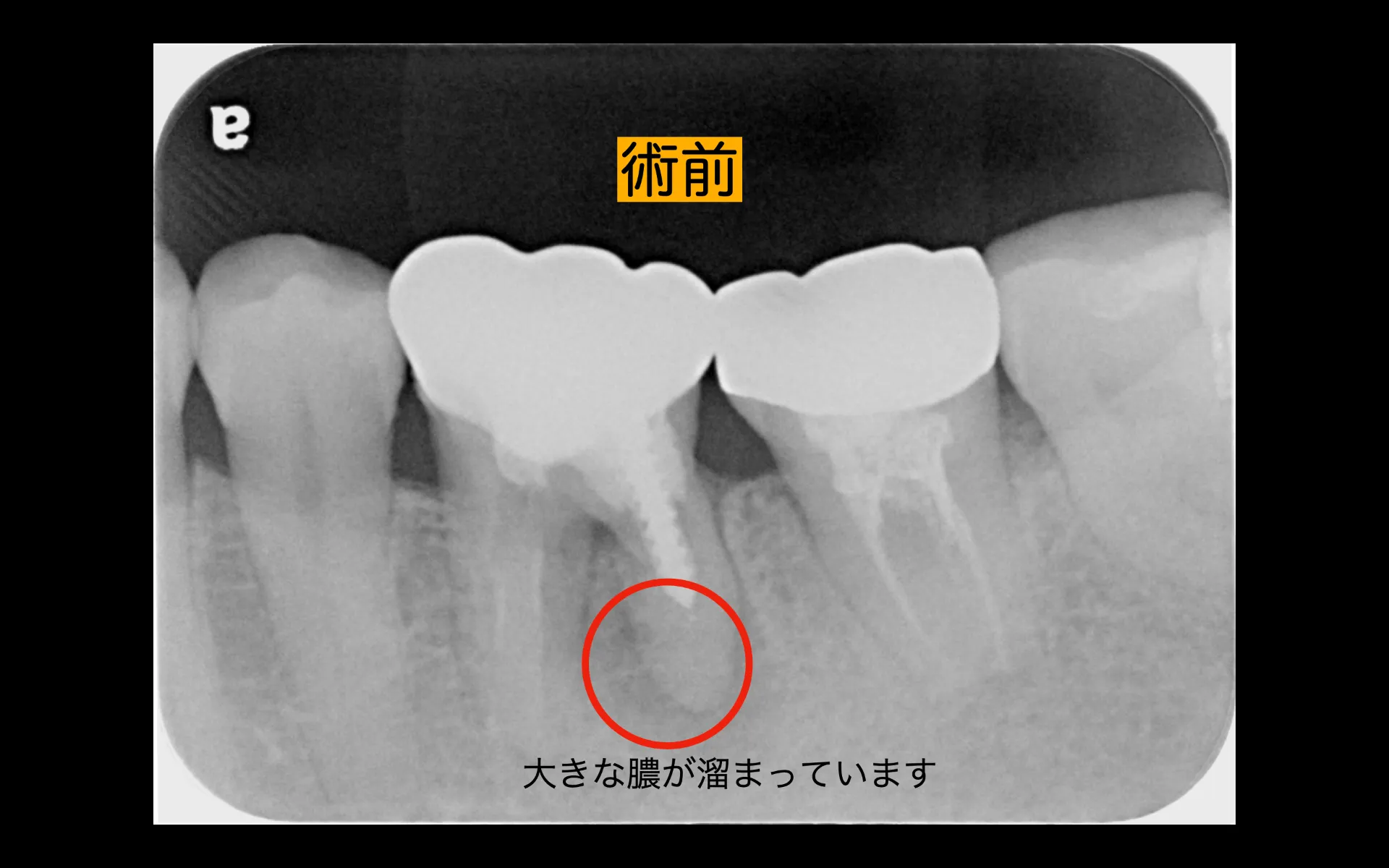抜歯即時インプラント治療