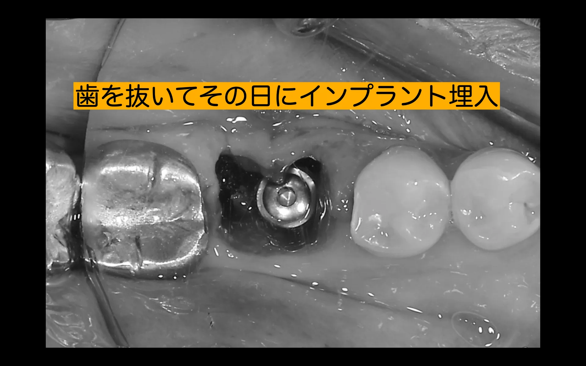 抜歯即時インプラント治療