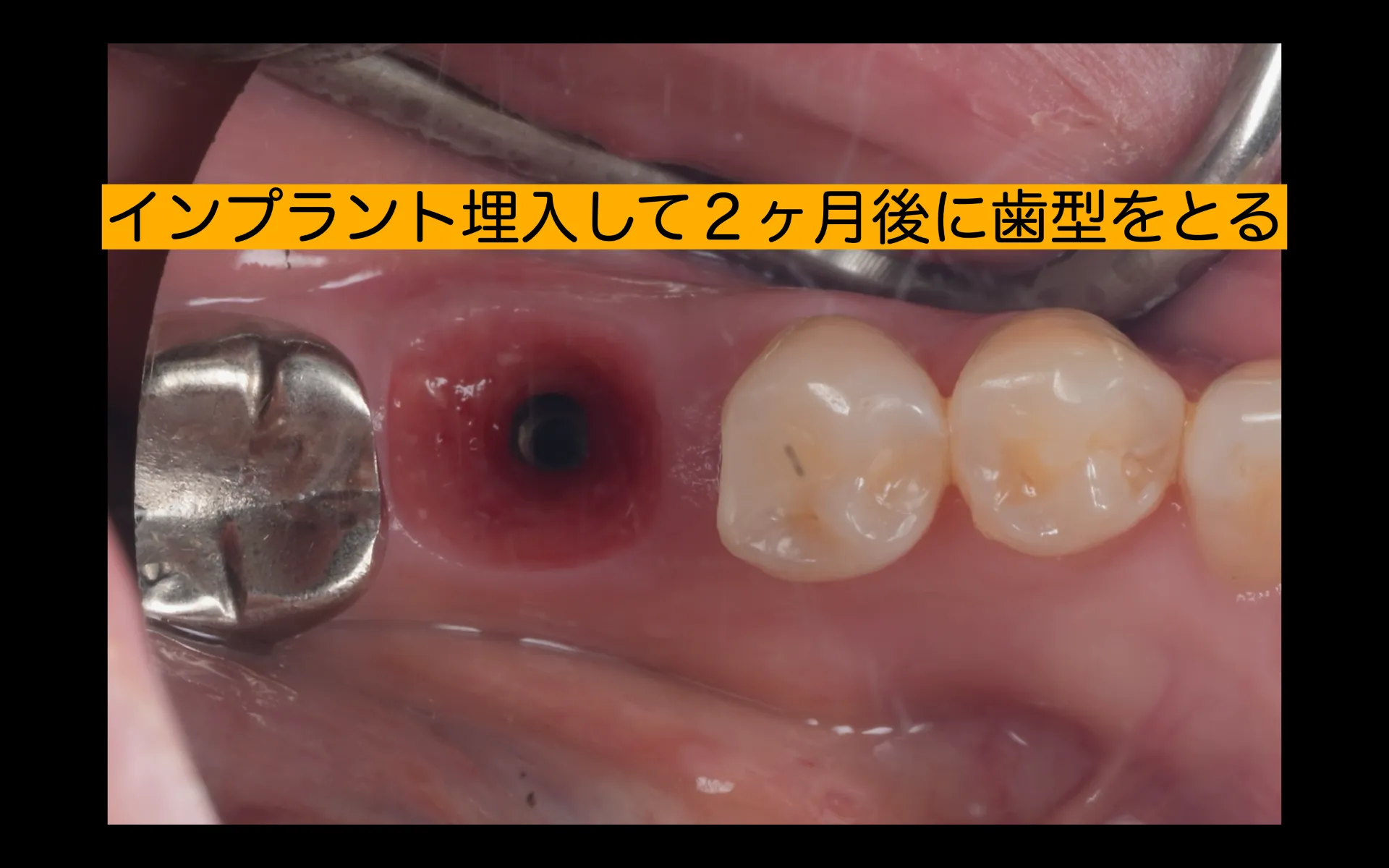 抜歯即時インプラント治療
