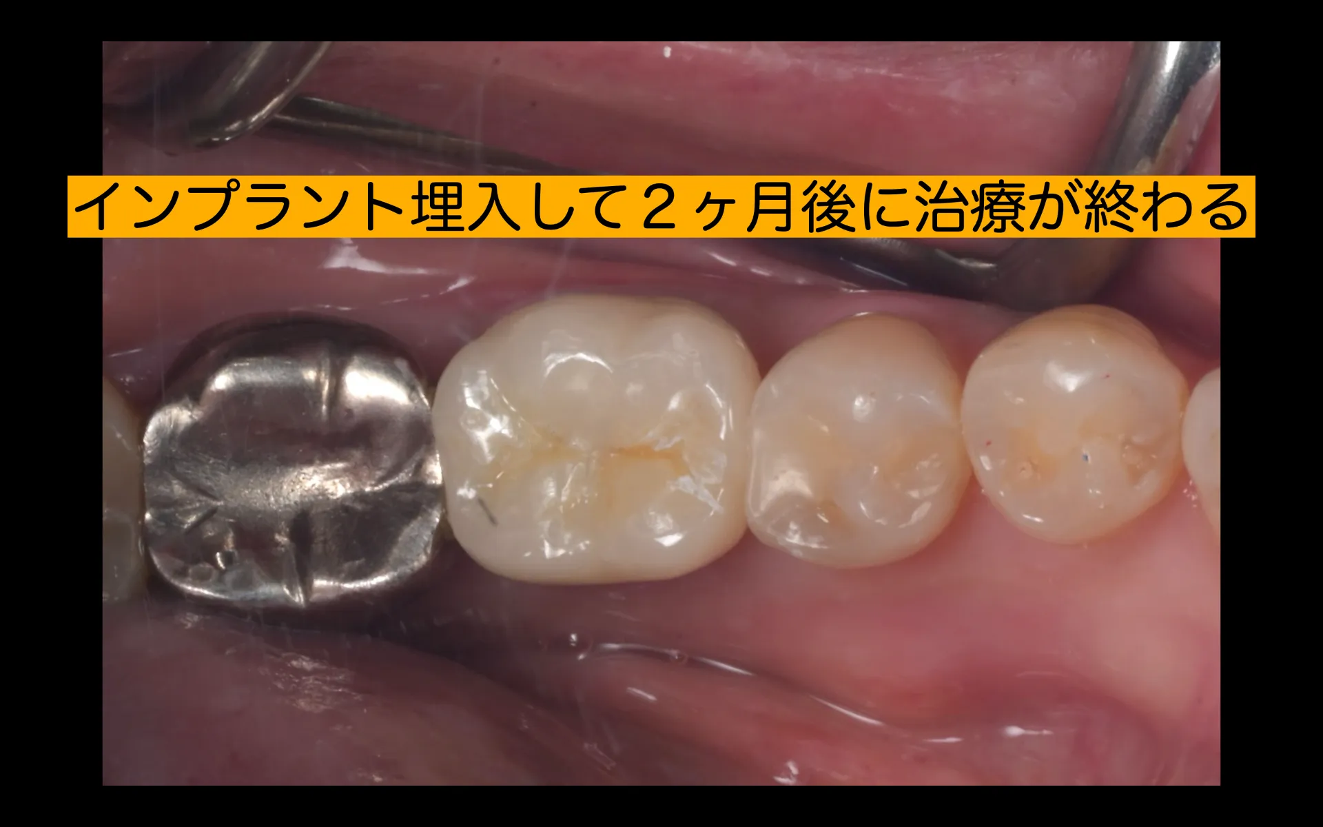 抜歯即時インプラント治療