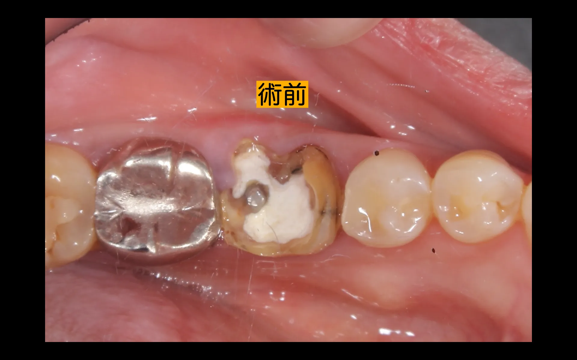 抜歯即時インプラント治療