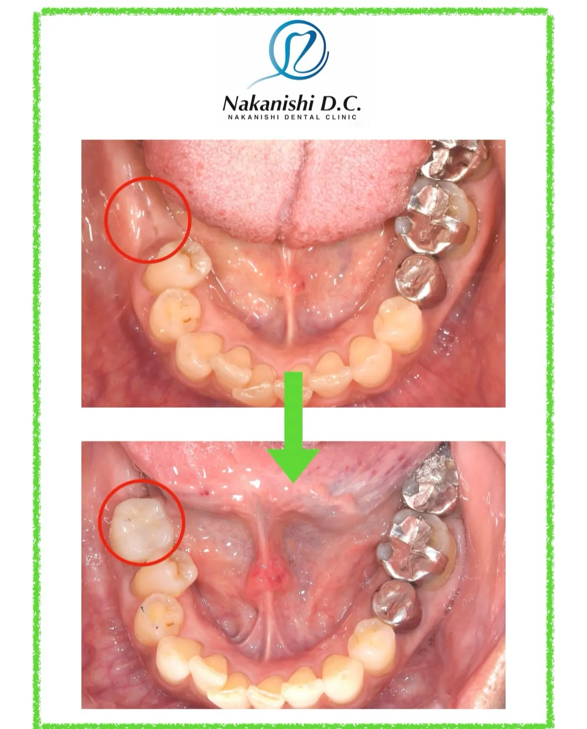 🦷 インプラント VS 入れ歯 🦷