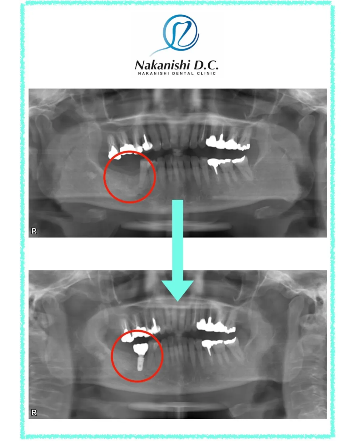 🦷 インプラント VS 入れ歯 🦷