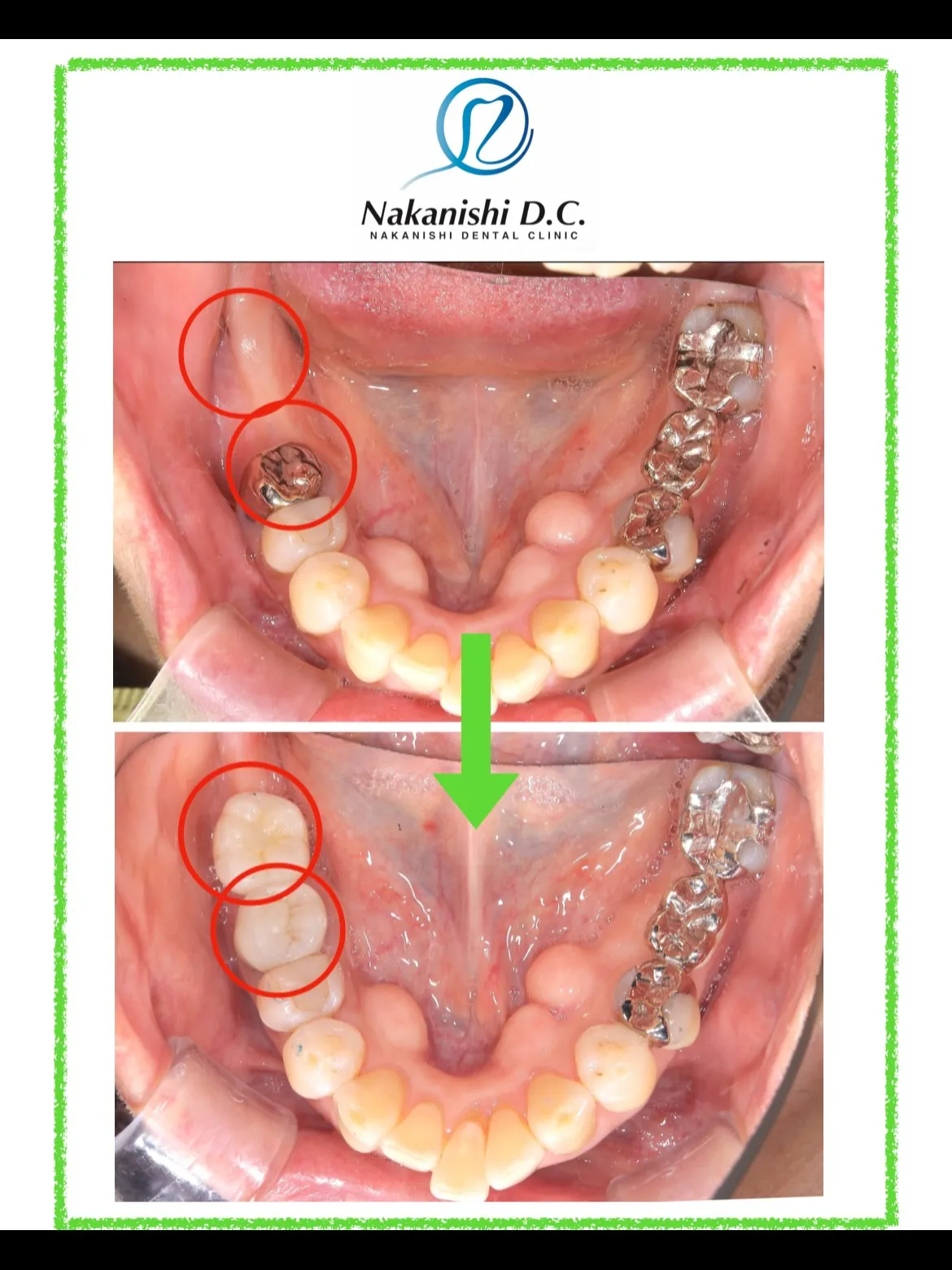 🦷 インプラントとセラミック補綴