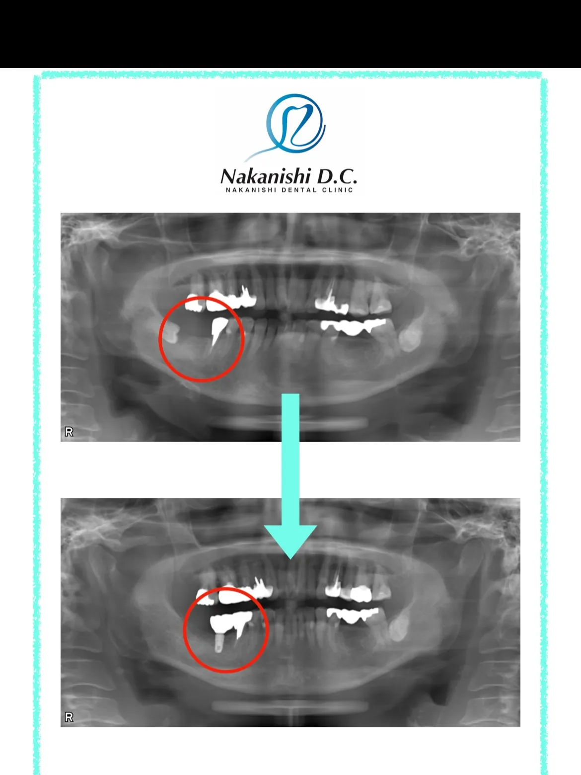 🦷 インプラントとセラミック補綴