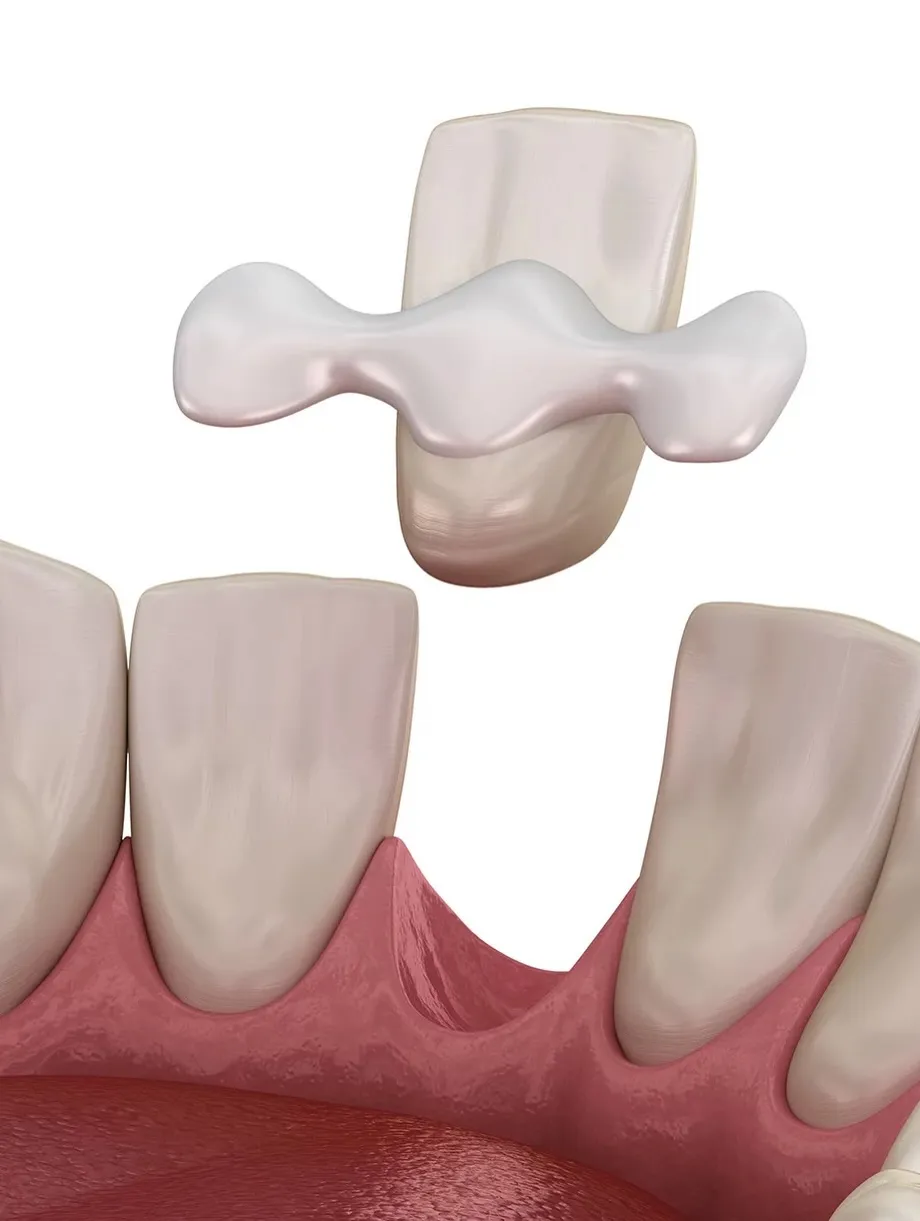 🦷 歯を大きく削らない「接着ブリッジ」という選択肢