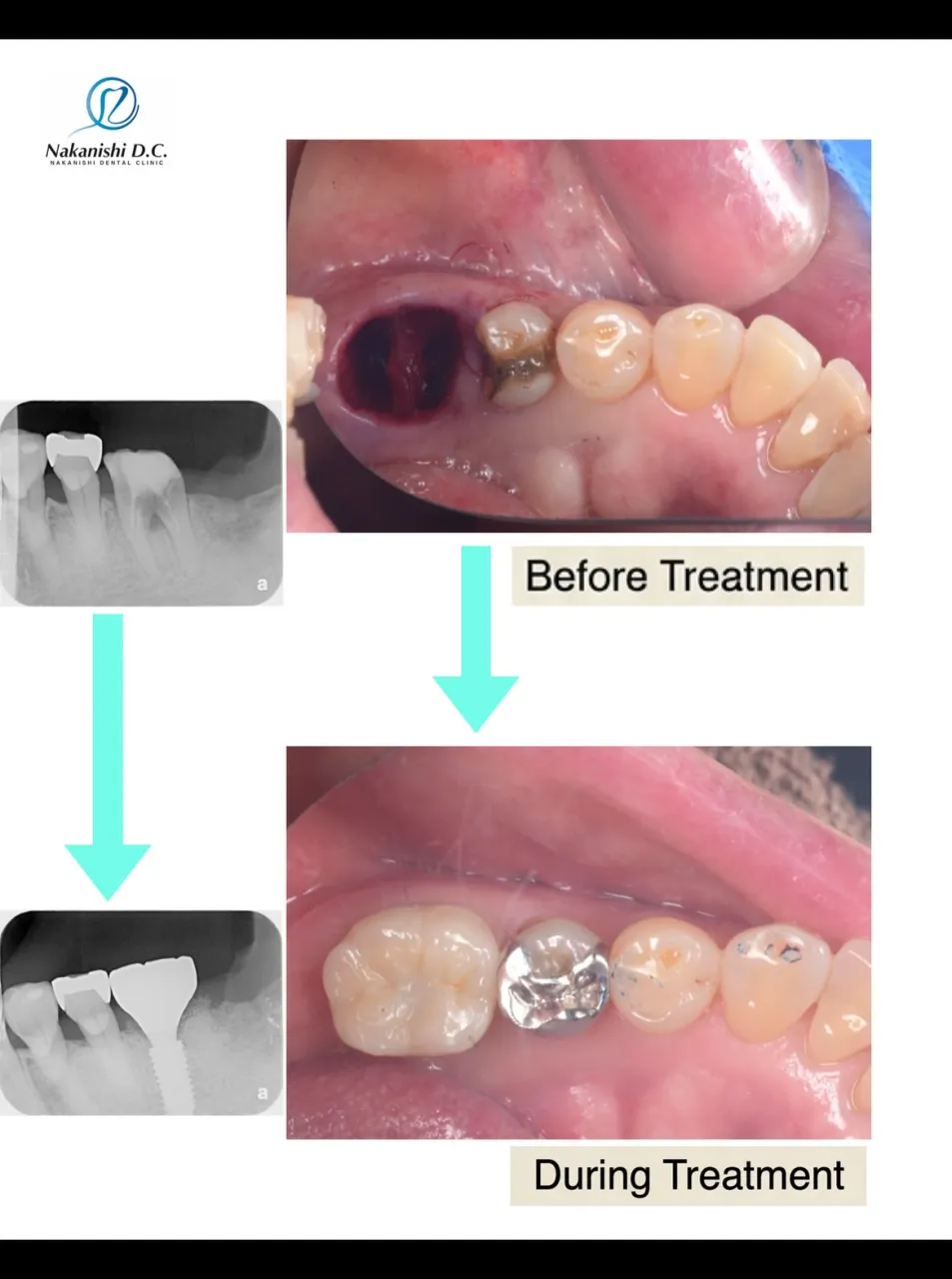🦷 抜歯即時埋入インプラント
