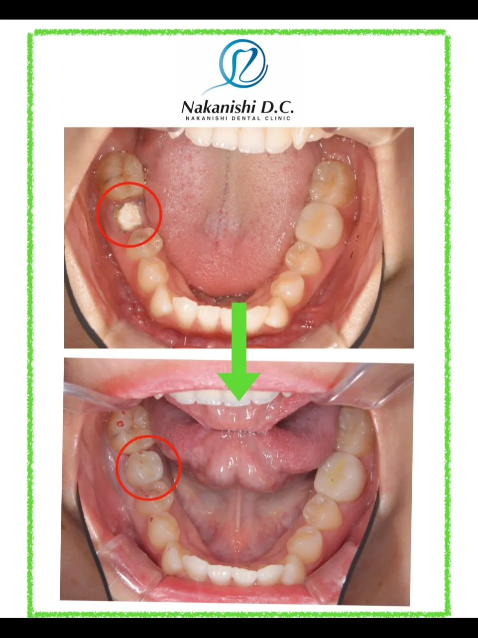 🦷 若年者のインプラント治療