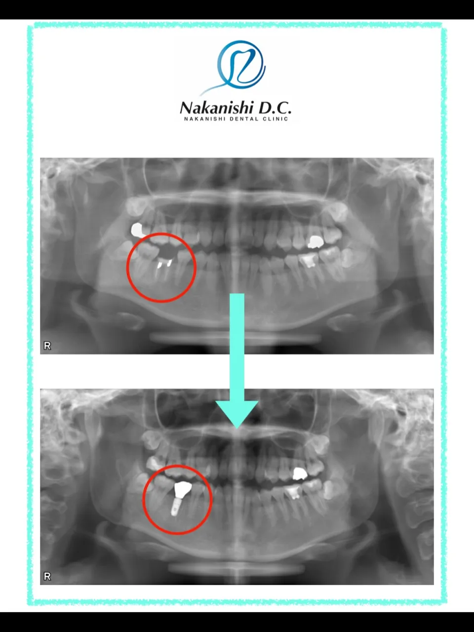 🦷 若年者のインプラント治療