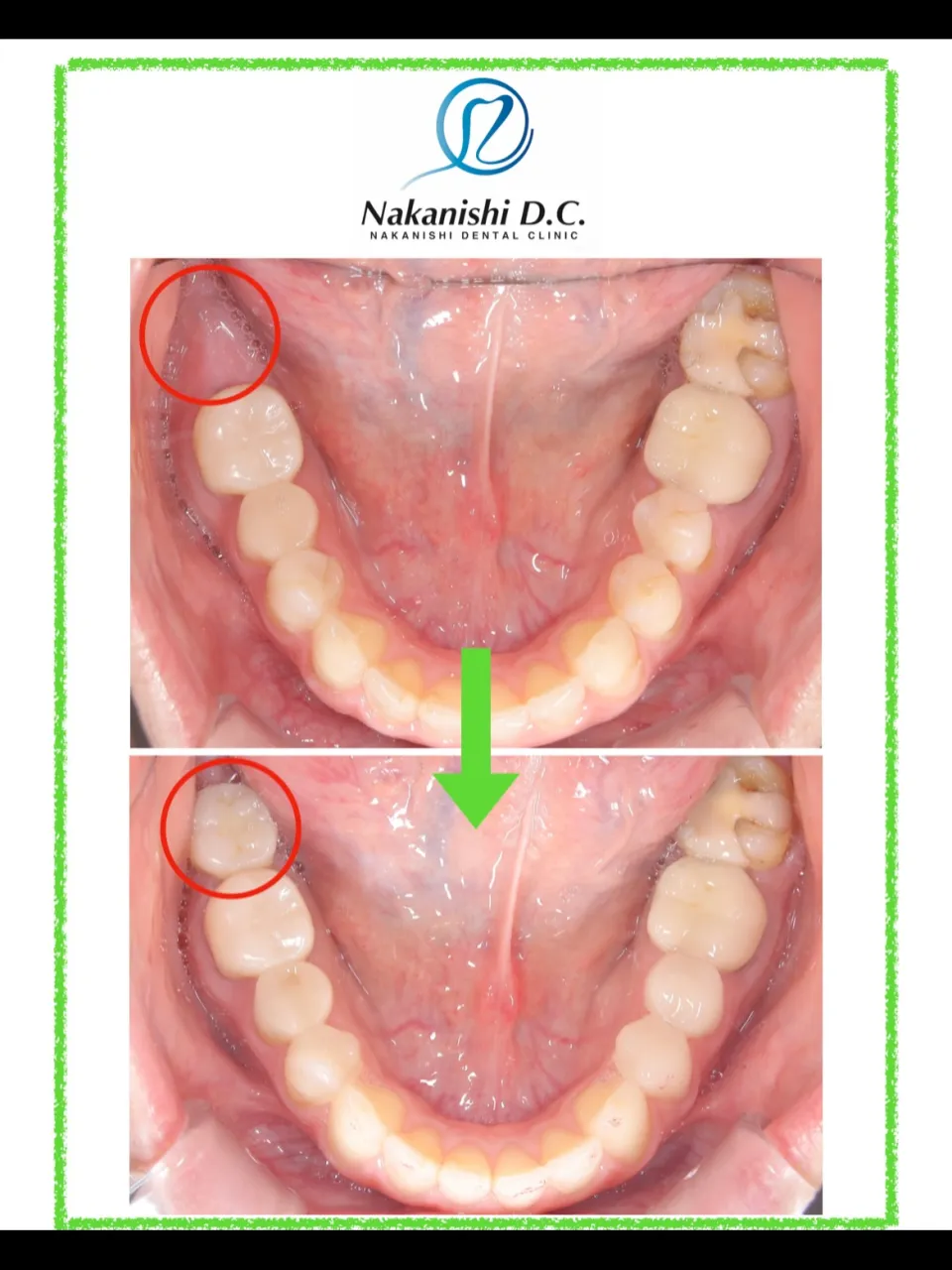 🦷 インプラントを長持ちさせるために大切なこと