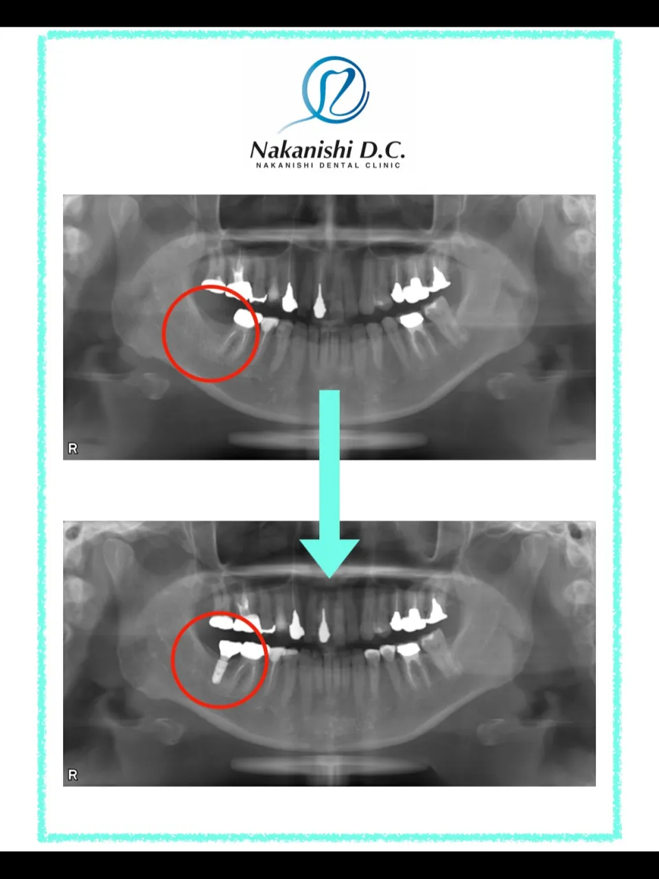 🦷 インプラントを長持ちさせるために大切なこと
