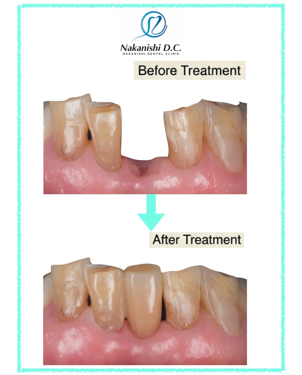 🦷 歯をできるだけ削らずに補う「接着ブリッジ」