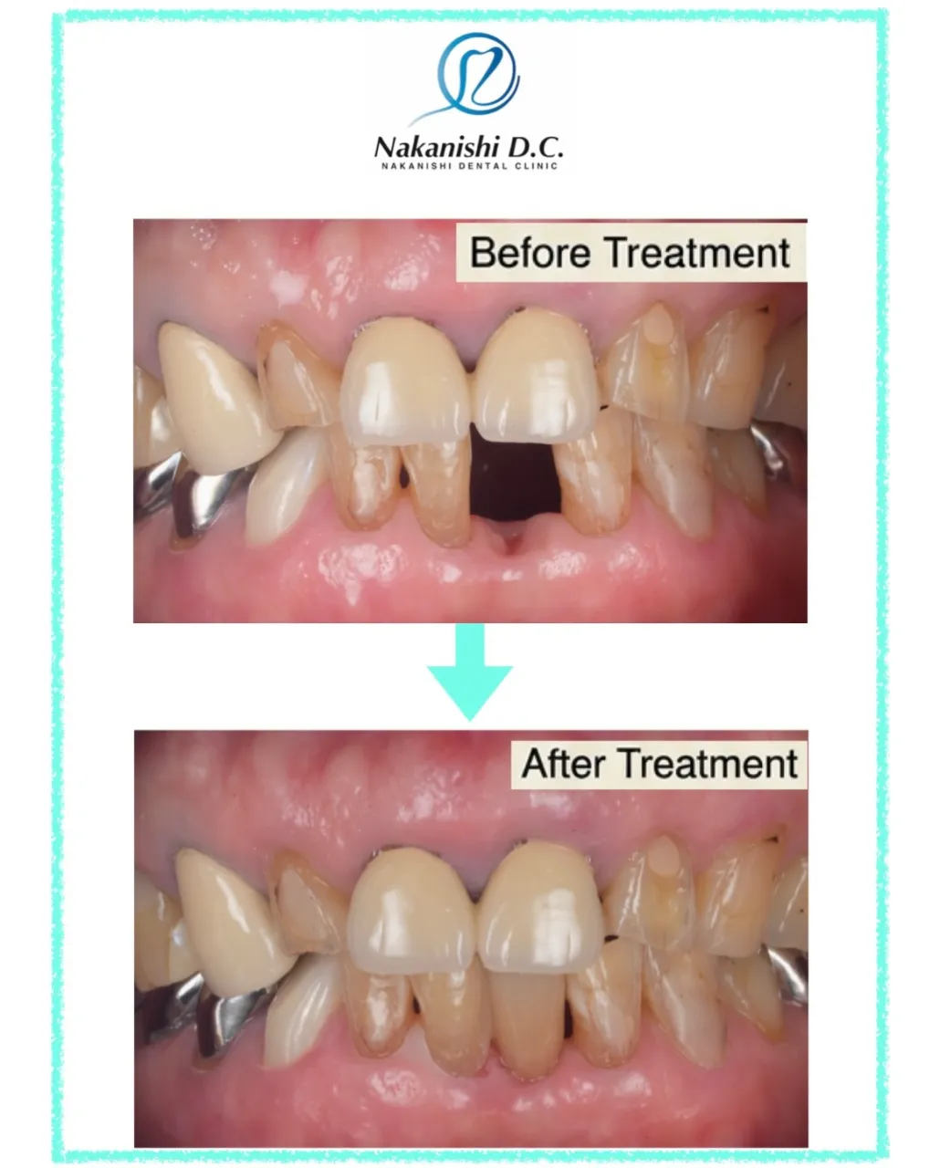 🦷 歯をできるだけ削らずに補う「接着ブリッジ」