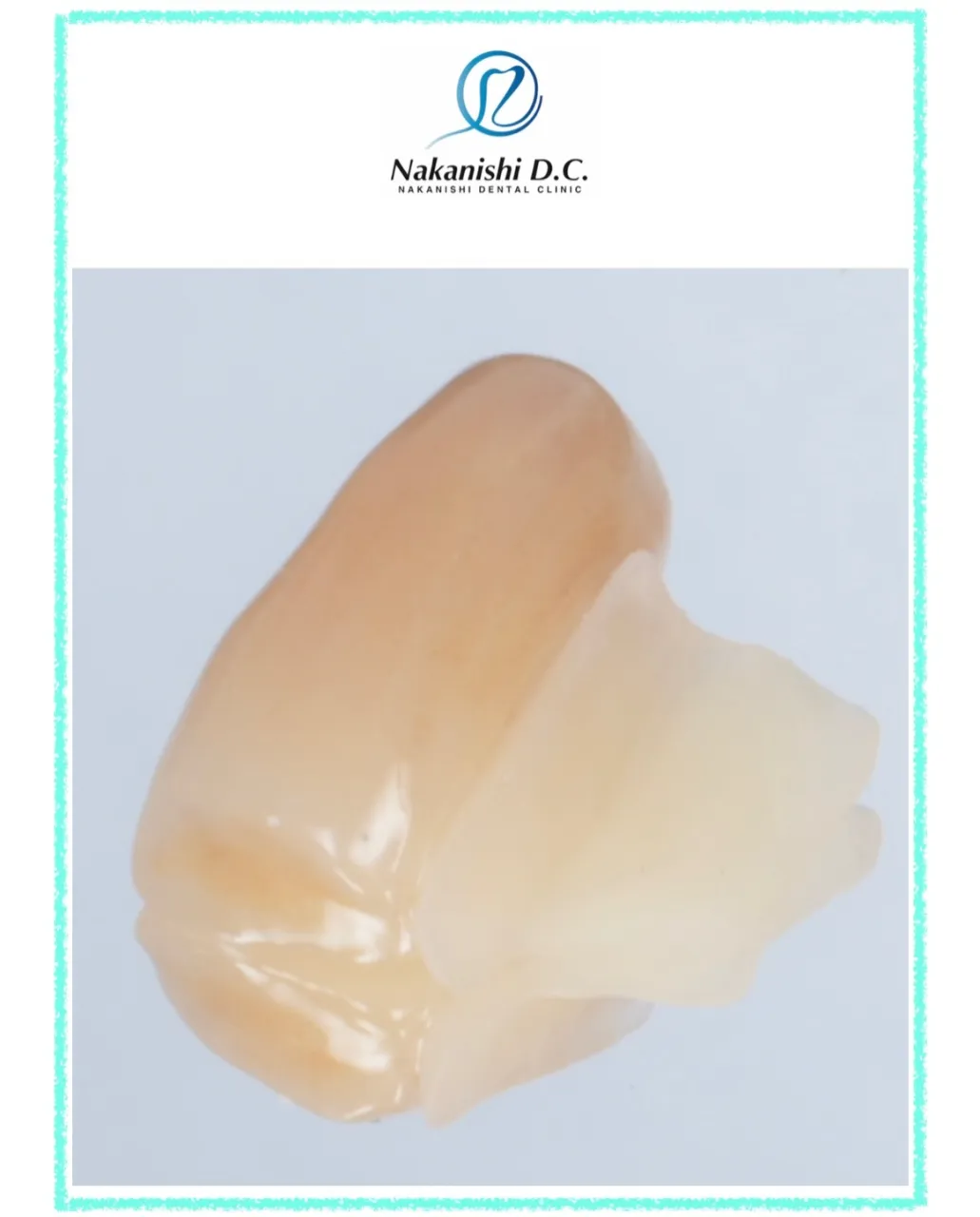 🦷 歯をできるだけ削らずに補う「接着ブリッジ」
