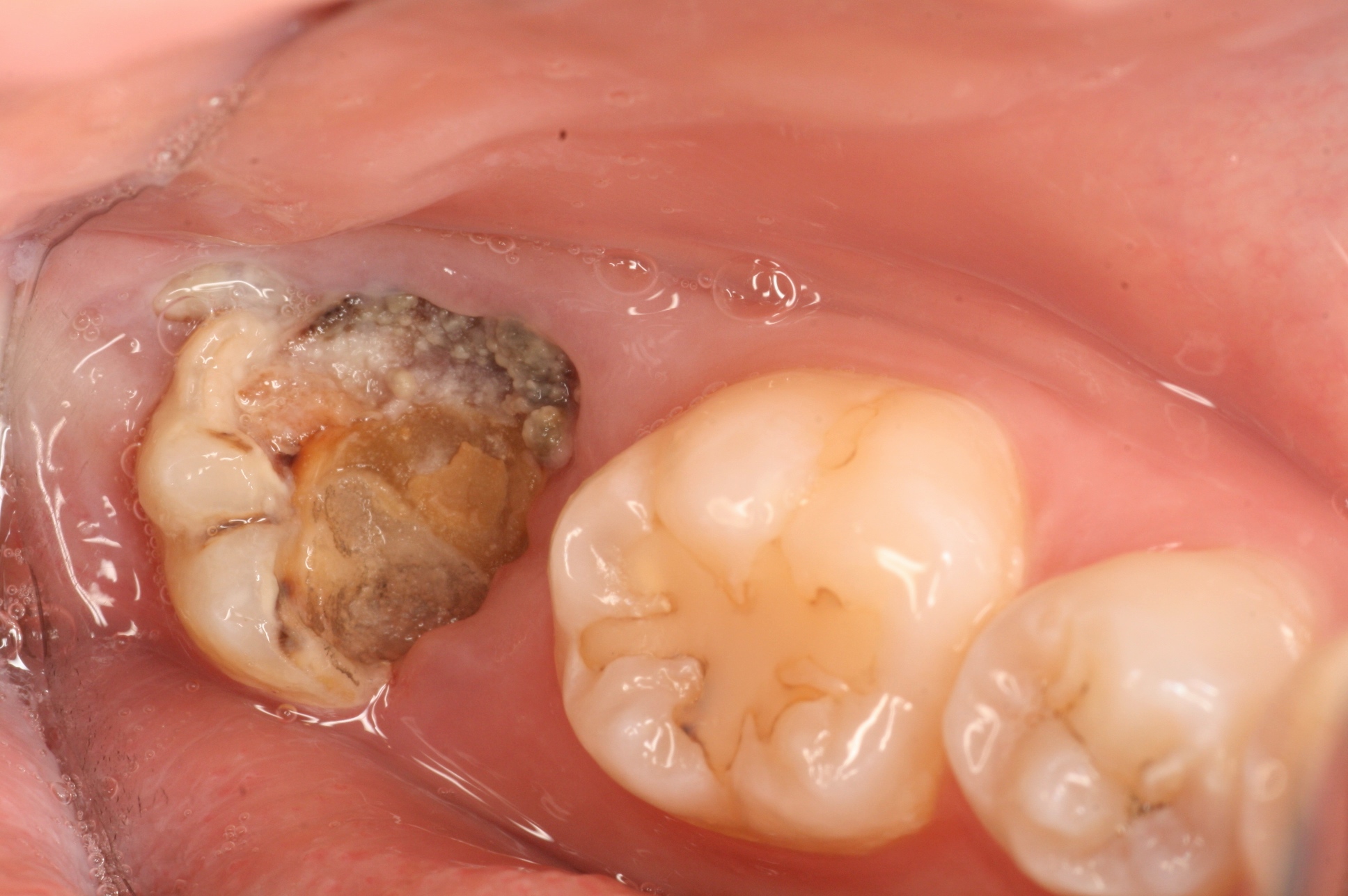 歯の移植の症例(初診)